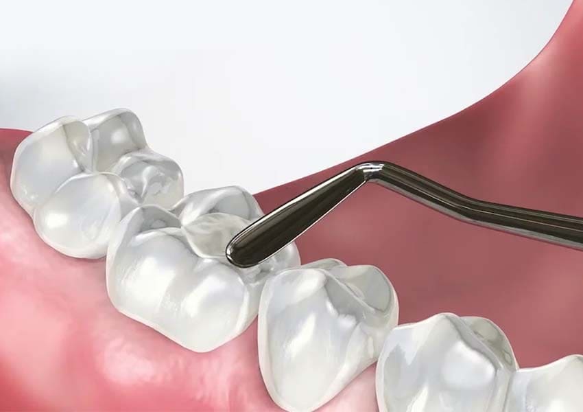 Cosmetic Fillings