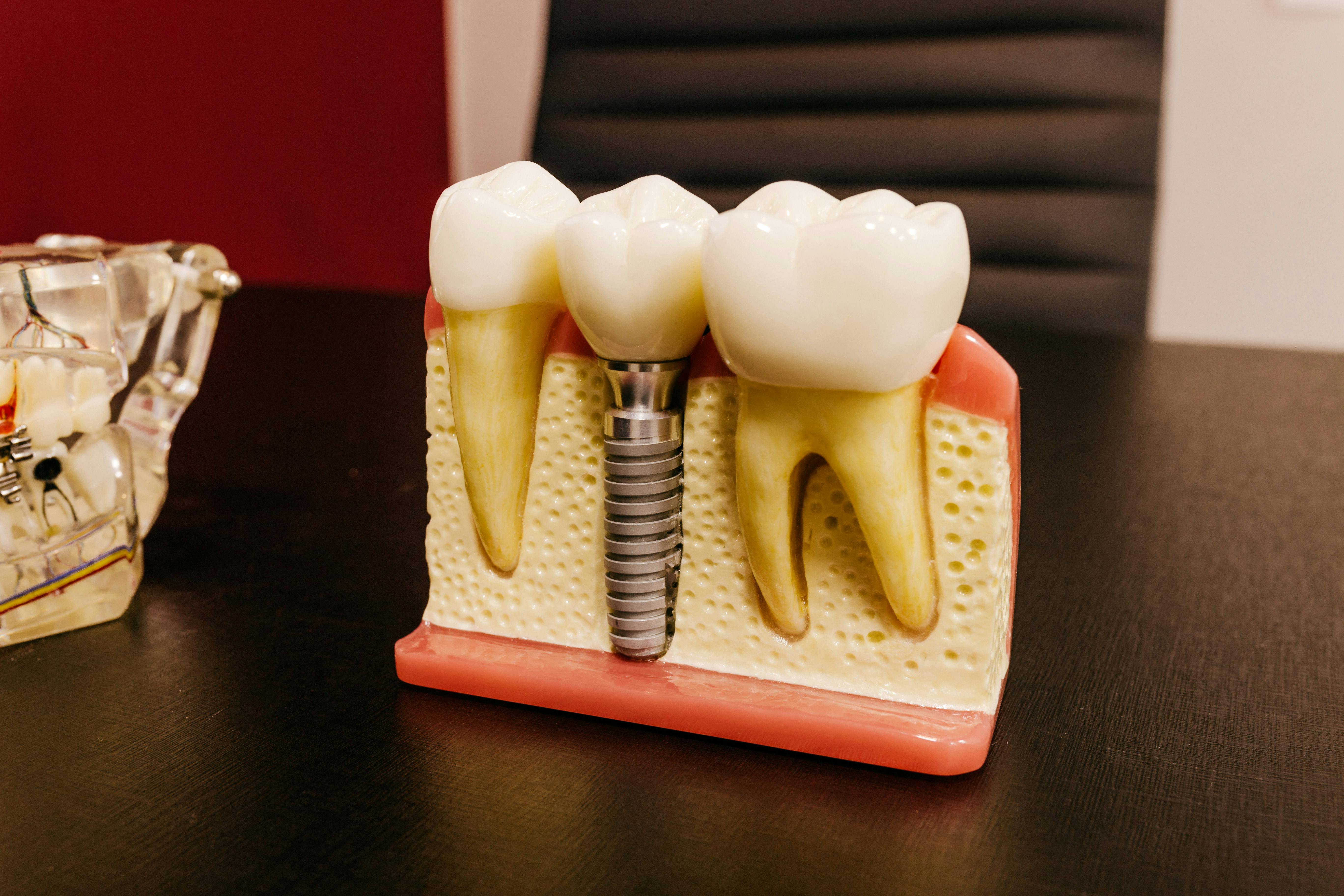 Immediate loading Implants