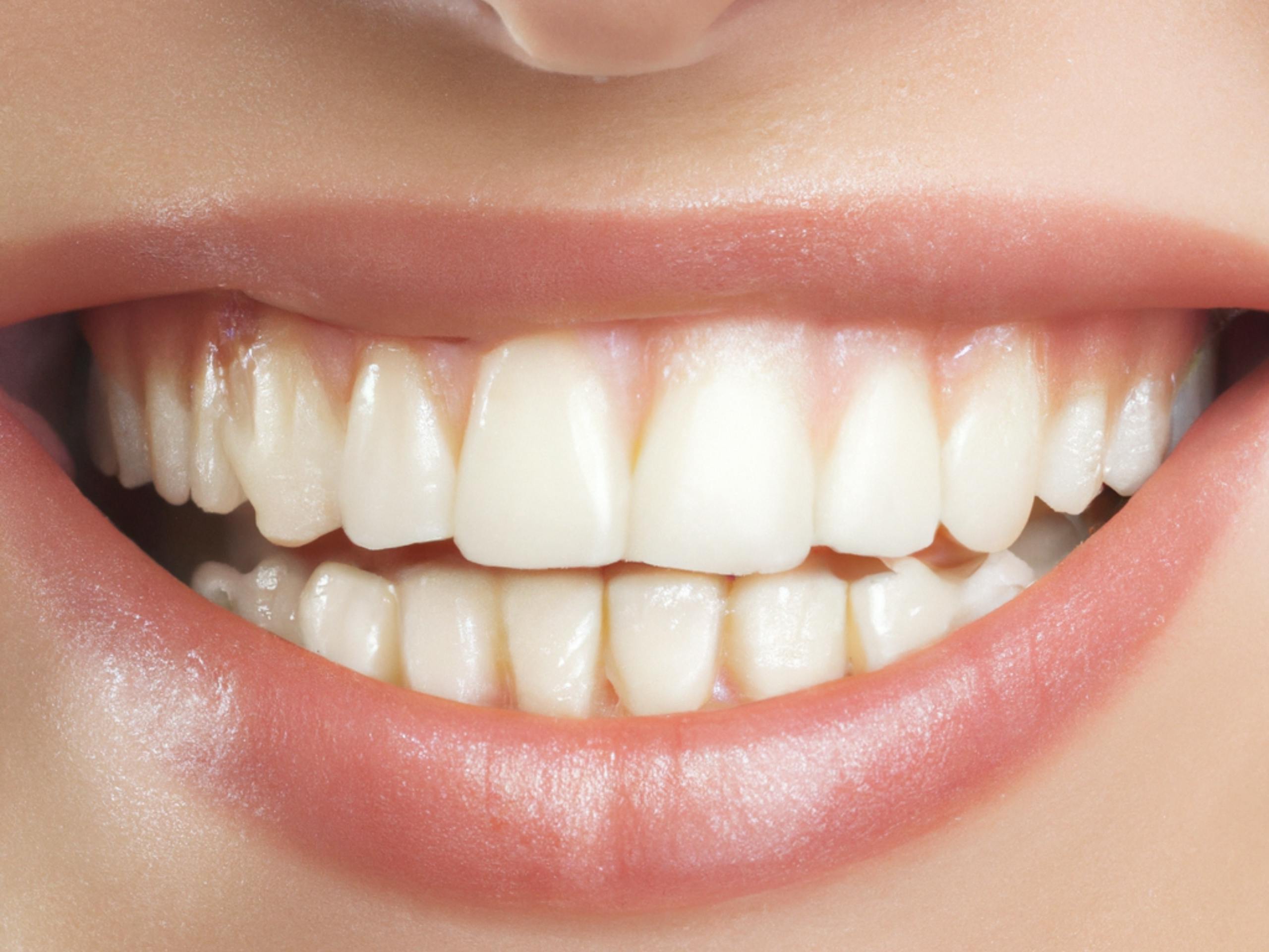 Smile Designing